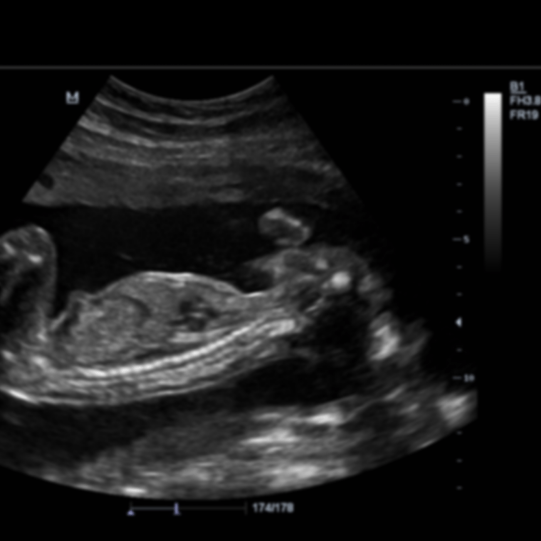 BMM Mini 003: It’s a Girl