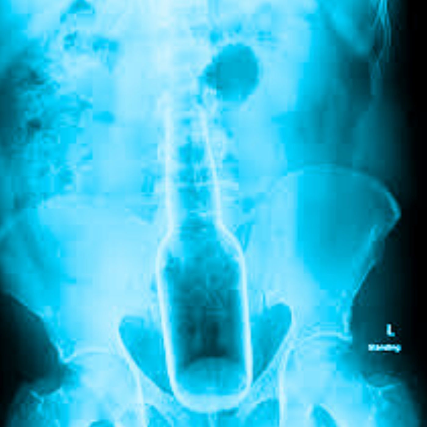 What was the most Embarrassing thing you've had to go to the ER for?