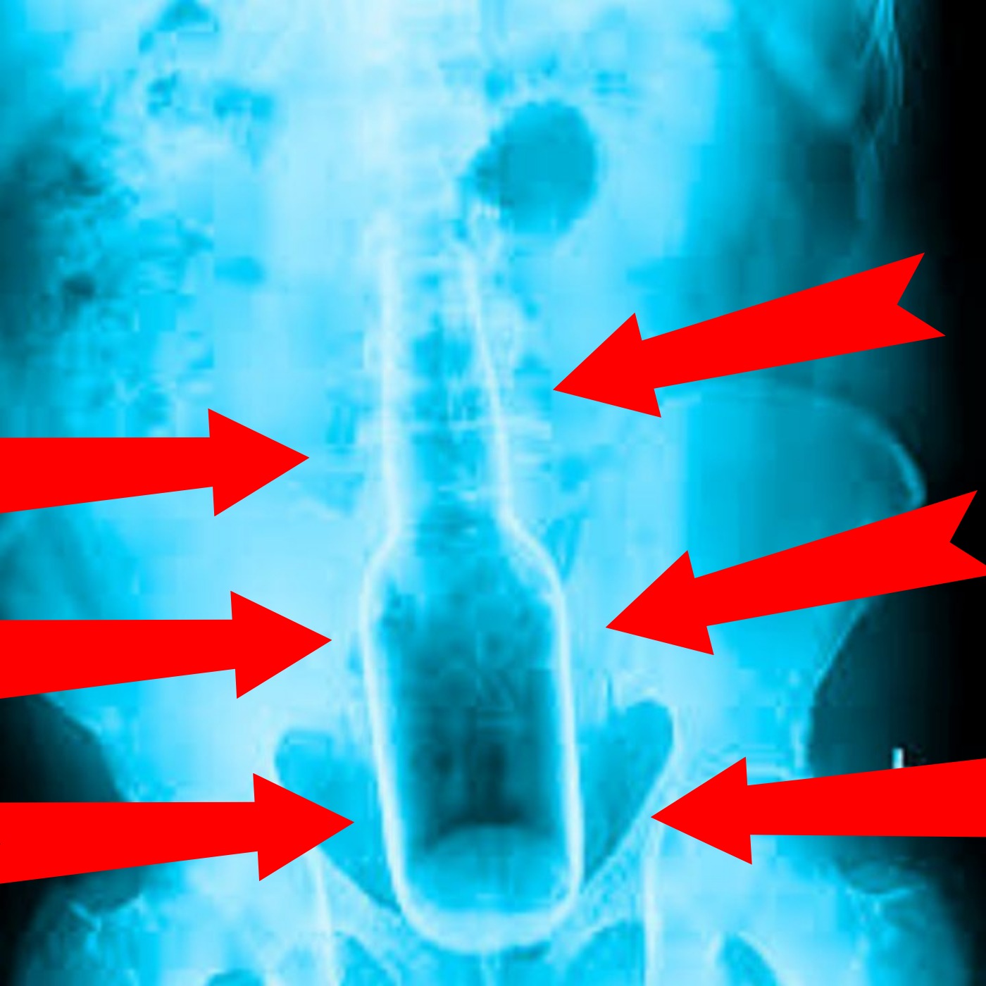 What was the most Embarrassing thing you've had to go to the ER for?