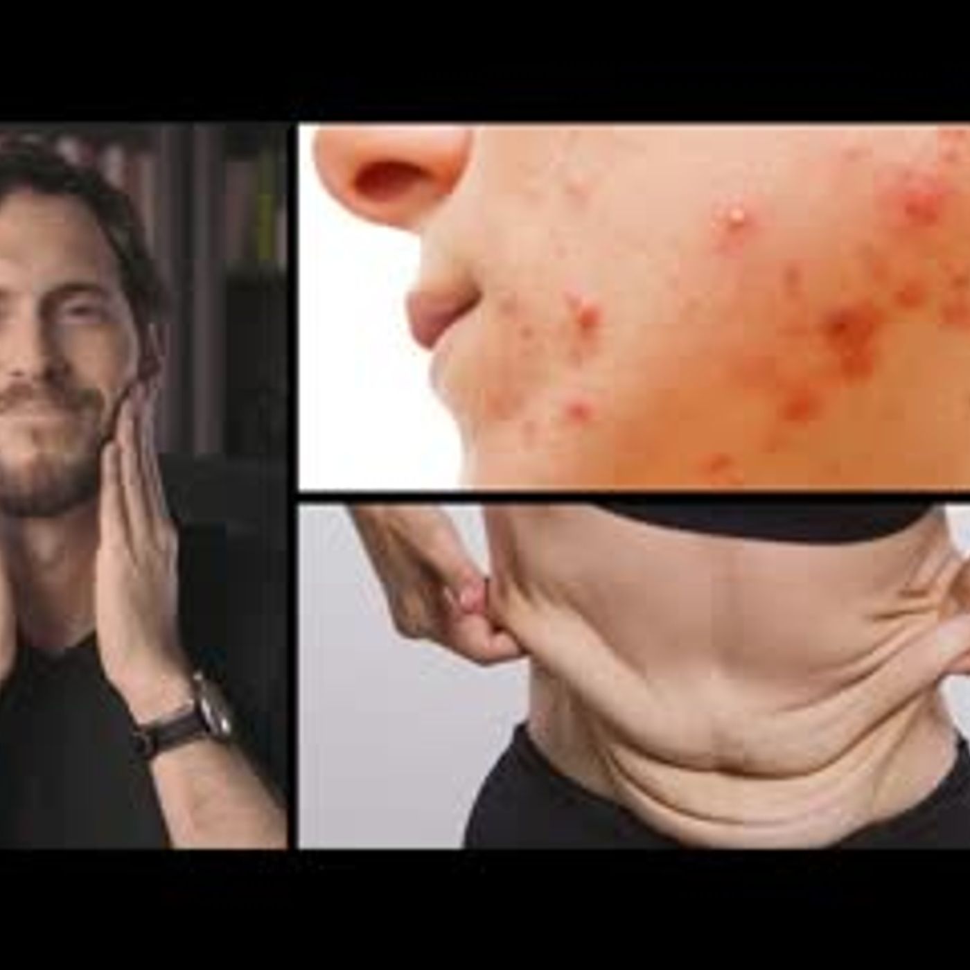 ¿Cómo tener una PIEL SIN ACNÉ ni FLACIDEZ? (ayuno intermitente, arrugas y suplementos)